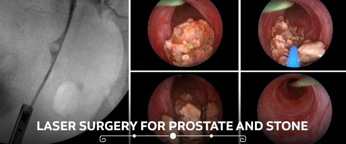 Kidney stone surgery in rewari